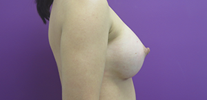 desai-breast-augmentation-2b