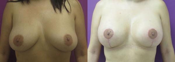  fotos antes y después en Long Island City, NY, Levantamiento de senos en New York, NY